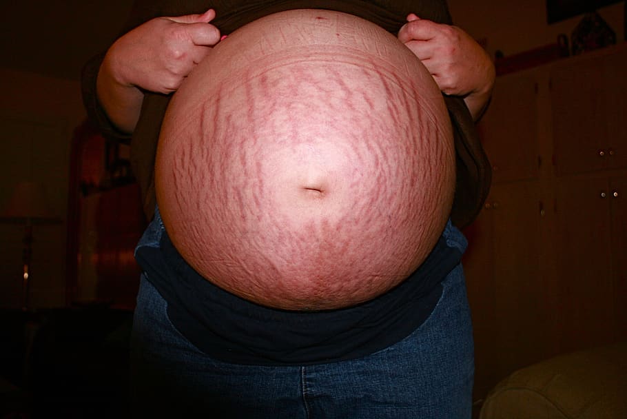 embarazada, embarazo, estrías, barriga, mujer, mujer embarazada, maternidad, abdomen, cuerpo, una persona
