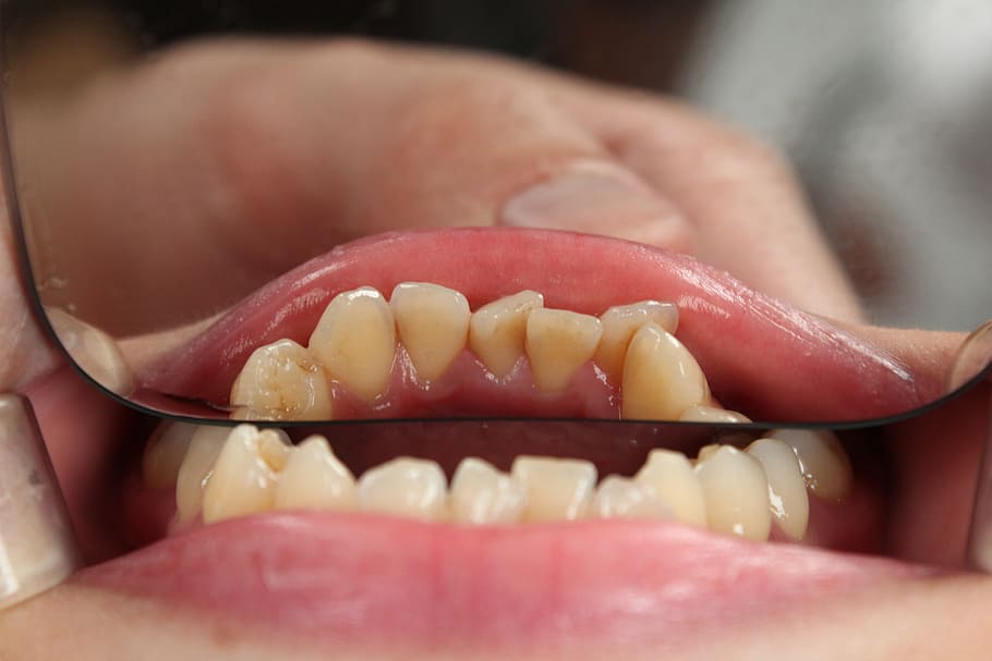dente, dentista, boca, odontologia, médico, boca humana, dentes humanos, parte do corpo humano, comida e bebida, comida
