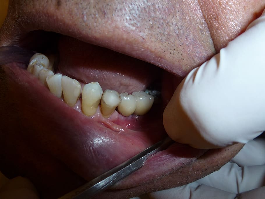 implant, dentistry, dentist, teeth, surgery, human body part, close-up, body part, human lips, human mouth