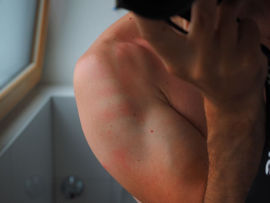 mano derecha de la persona, quemaduras solares, piel, rubor, dermatología, rojo, quemado, irritación de la piel, calor, dolor