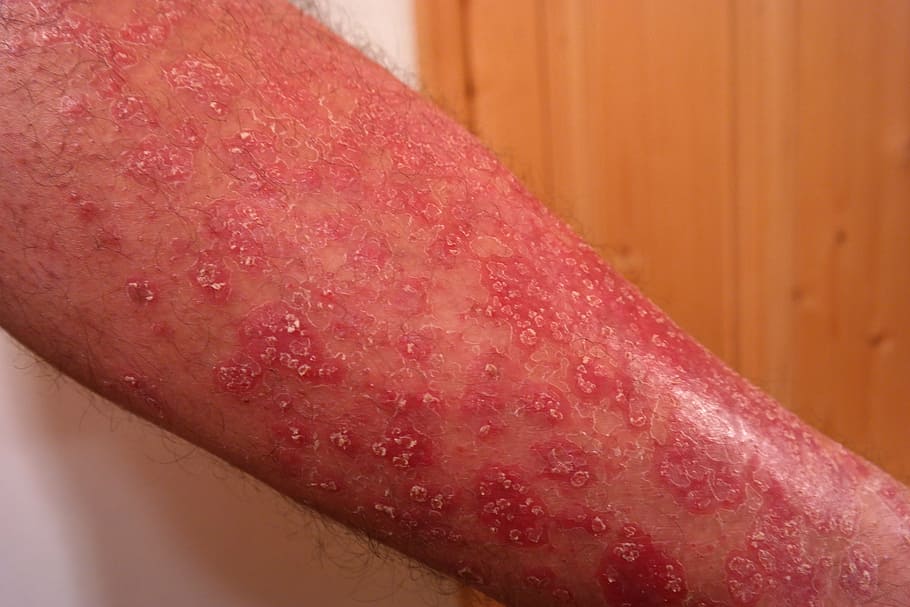 condición de la piel humana, psoriasis, heutkrankheit, rojo, escamoso, piel, enfermedad inflamatoria de la piel, dermatosis, enfermedad del sistema, mono morfo