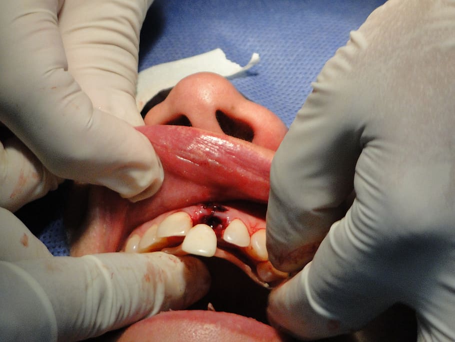 surgery, teeth, operation, stomatology, implant, human hand, healthcare and medicine, human body part, hand, hospital