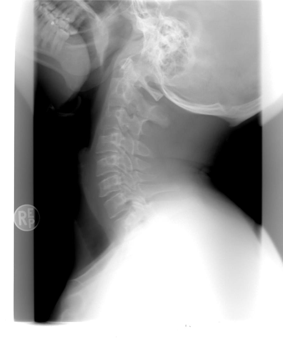 spine x-ray, xray, cervical spine, healthcare, injury, x-ray image, bone, medical x-ray, human body part, people