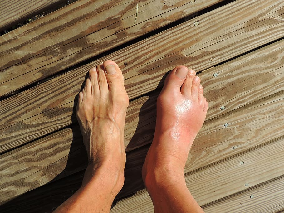 person's foot, Feet, Gout, Pain, Foot, Human, Anomaly, barefoot, flatfoot, toes