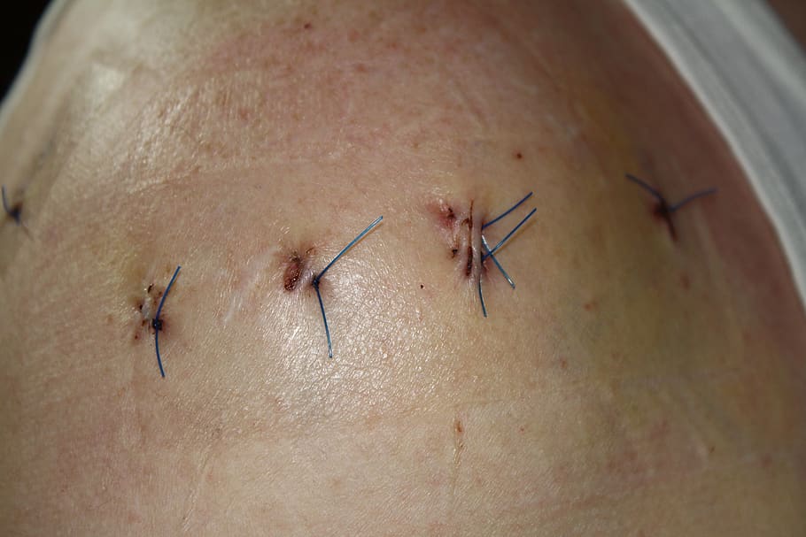operation, stitches, sew, shoulder, threads, surgeon, surgical intervention, pain, sewn, intervention
