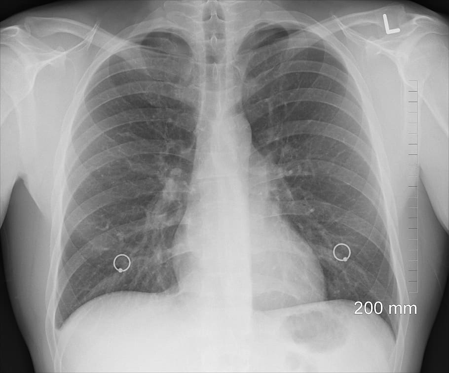 diagnosis, xray, chest, lungs, ribs, body, human, organs, bone, medicine