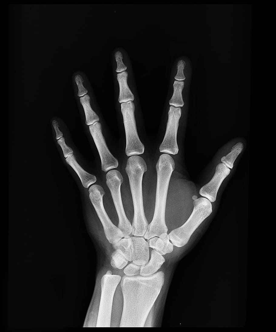 radiografía de la mano, radiografía, salud, brazo, médicos, medicina, hueso, hospital, seguro médico, diagnóstico