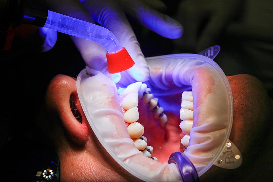 person, dental, session, dentist, facet, uv light, curing, teeth, mouth, treatment
