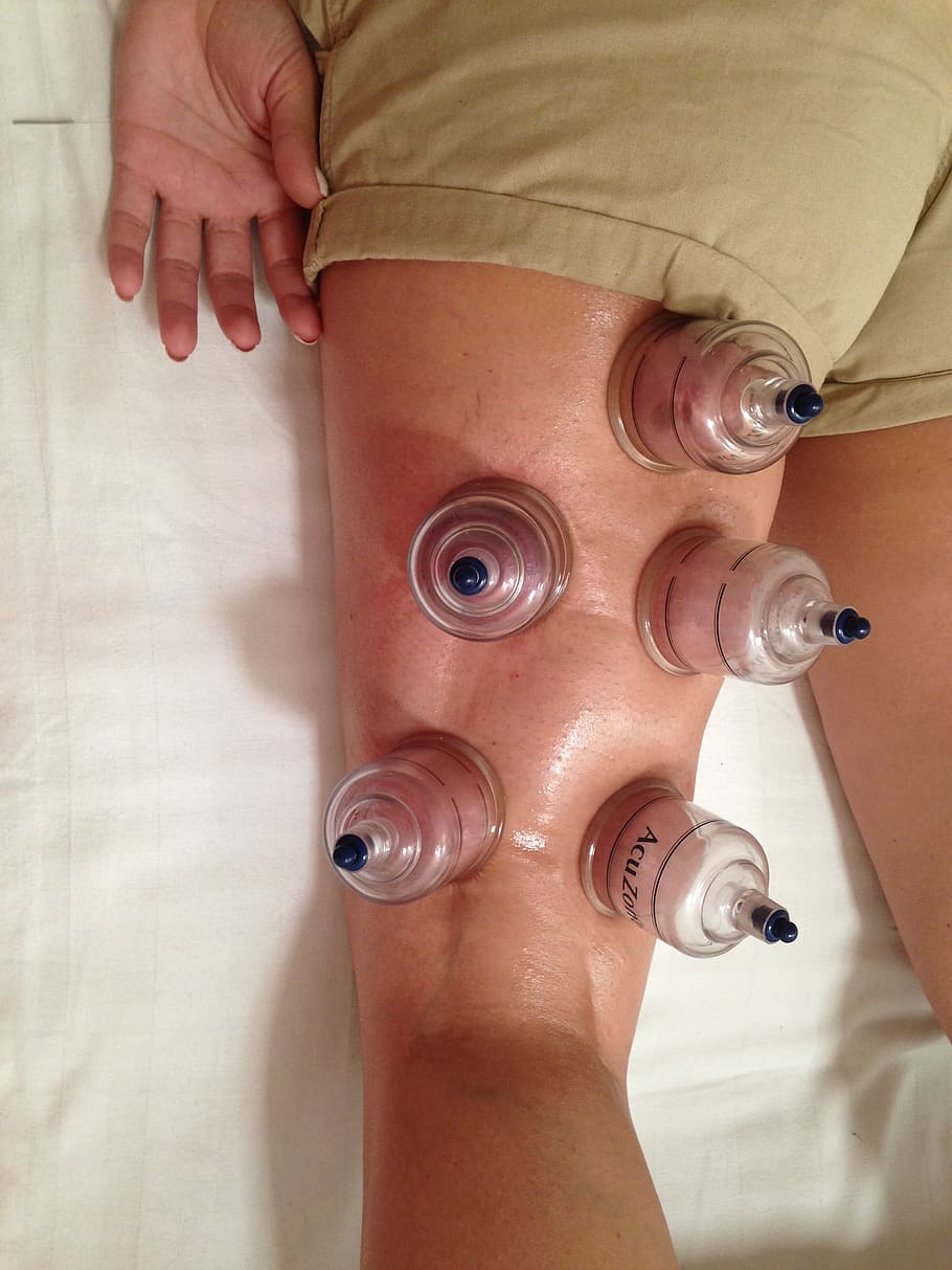 five, ventosa glasses, person, back, leg, Cupping, Acupuncture, Alternative, therapy, chinese