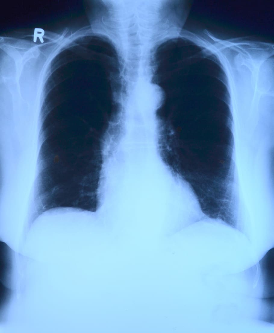 foto de rayos x, rayos x, tórax, rayos x de pulmón, examen médico, médico, asistencia sanitaria y medicina, hospital, atención médica y medicina, parte del cuerpo humano