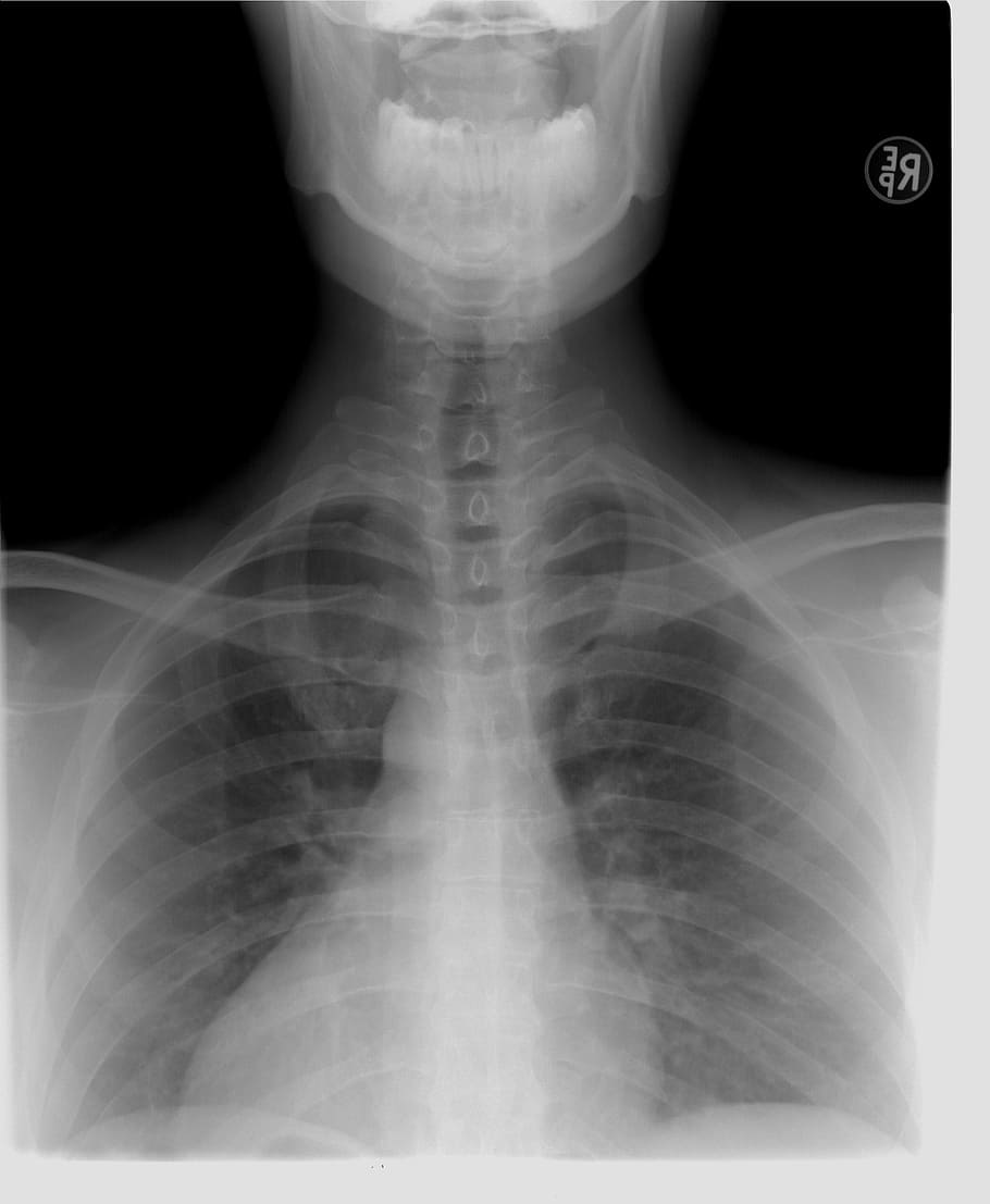 chest x-ray, xray, thoracic spine, diagnosis, x-ray image, bone, healthcare and medicine, medical x-ray, human body part, human bone