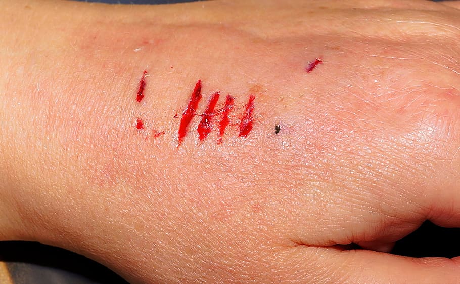 condição de pele humana, mão, lesão, mordida, mordida de cachorro, doloroso, sangue, ferindo, rachaduras, pele