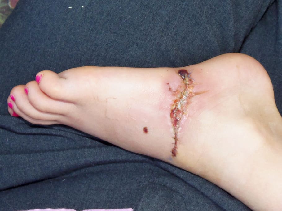 surgery, recovery, painful, stitches, foot, medical, pain, gross, yuck, human body part