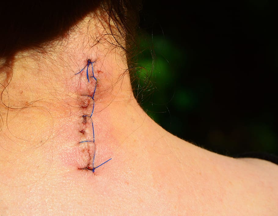 person, stitched, nape, discogenic operational, wound, seam, sewn, operation, cervical spine, scar