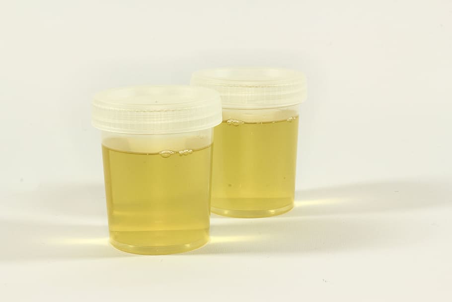 two, clear, plastic containers, filled, yellow, liquid, the test, urine container, urine, inflammation
