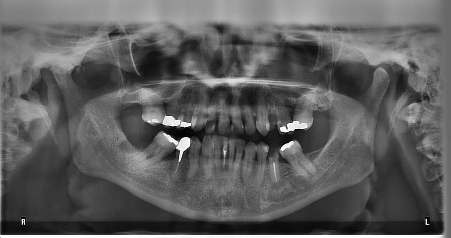 x-ray, tooth, radius, ugly, jaw, dental fillings, human body part, human teeth, mouth, people