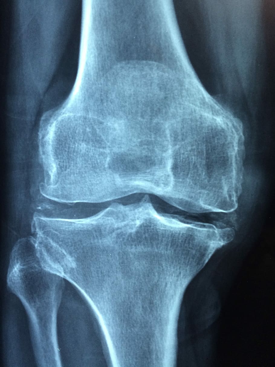x-ray results, bone, X-ray, knee, old, care, injury, pain, knee pain, inflammation