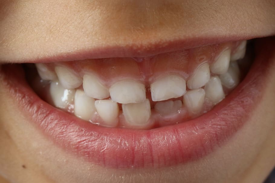 pessoa dentes brancos, dentes, sorriso de criança, criança, dental, dentes de sorriso, dente, higiene, limpo, sorrindo