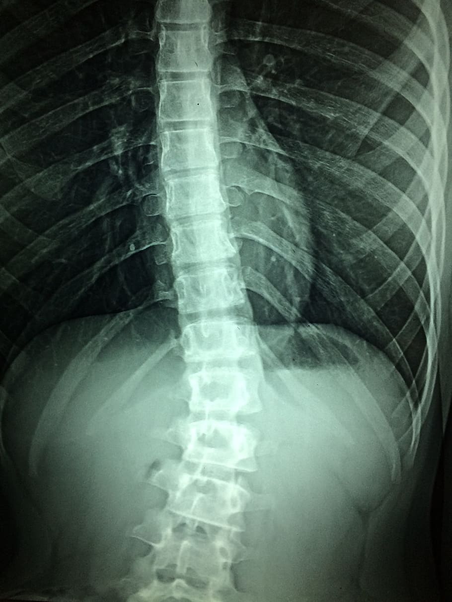 resultado de la radiografía, rayos X, hospital, discapacidad, médico, paciente, atención, médula espinal, enfermedad, clínica