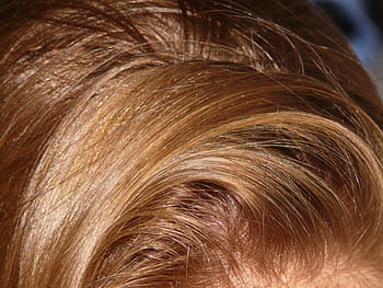 hair loss causes in females