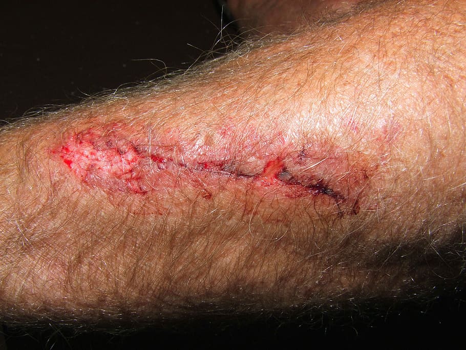 person showing wound, Arm, Wound, Pain, Injury, Patient, trauma, hurt, human, skin