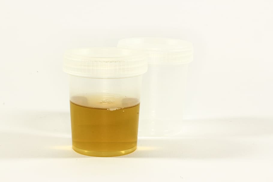 o teste, recipiente de urina, urina, inflamação, análise, médico, laboratório, tubo, diagnóstico, pesquisa