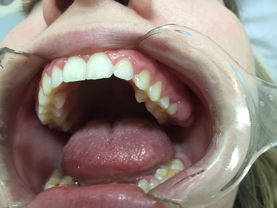 boca de la mujer, dentista, boca, abierto, herramienta, boca abierta, cuidado dental, dientes, parte del cuerpo humano, primer plano