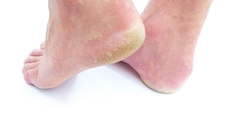 cornea, skin, foot, sole of the foot, heel, barefoot gear, fusspflege, mushroom, human, pain