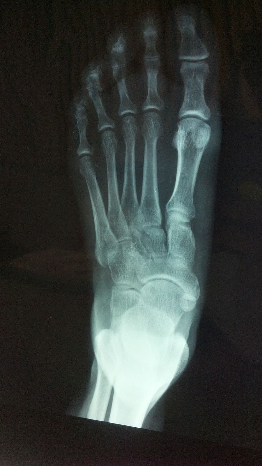 x-ray, kiri, kaki, closeup, foto, x ray, tulang, x-ray medis, gambar x-ray, bagian tubuh manusia