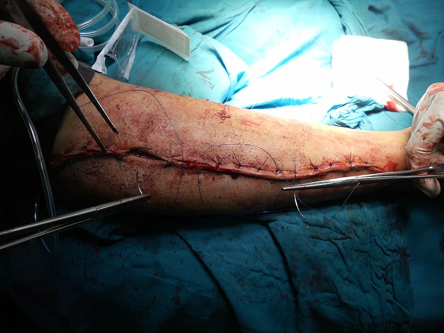 person, arm surgery, surgery, orthopedic, arm, hospital, doctor, healthcare, medicine, body