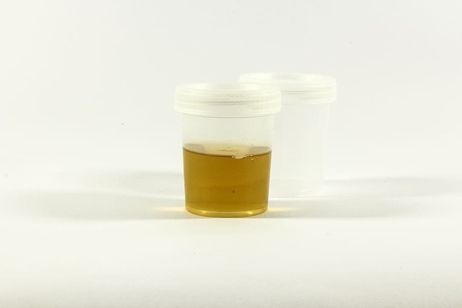 the test, urine container, urine, inflammation, analysis, medical, laboratory, tube, diagnostics, research