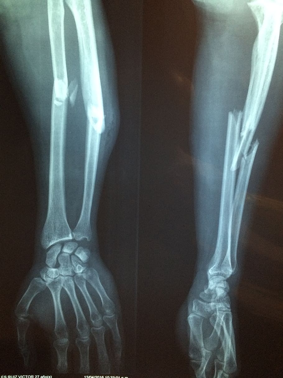 resultado de raio-x, fratura óssea, raio x, esqueleto, diagnóstico, quebrado, saúde, hospital, radiologia, cirurgia