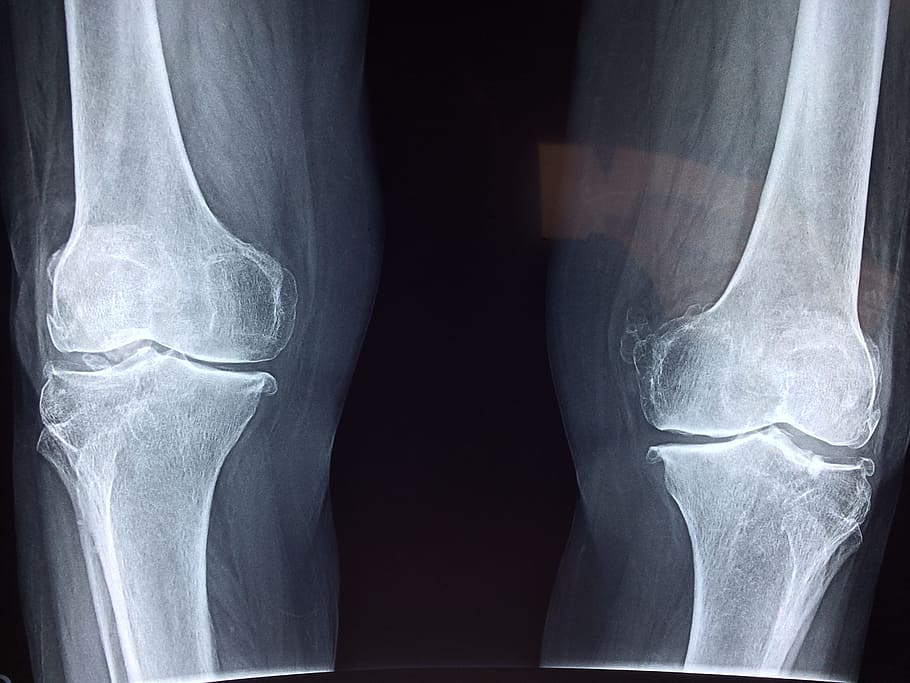foto, humano, resultados de rayos X de rodillas de pierna, rodilla, rayos X, médico, anatomía, esqueleto, hueso, ortopédico