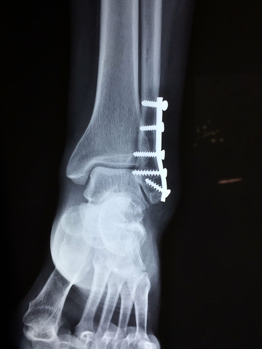 resultado del ultrasonido óseo, tobillo, fractura, pie, médico, accidente, trauma, salud, lesión, pierna