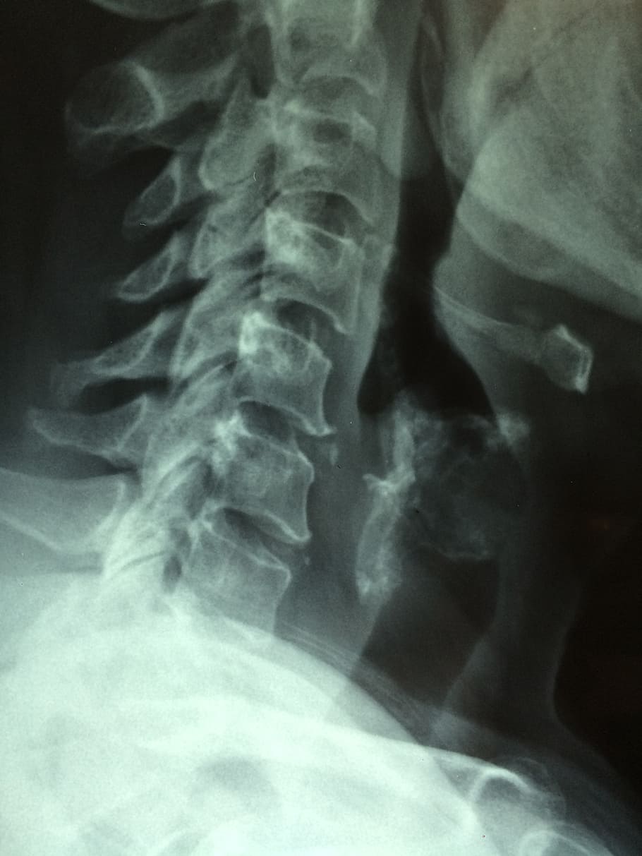 closeup, human, neck x-ray, cancer, x-ray, scan, disease, examination, oncology, physician