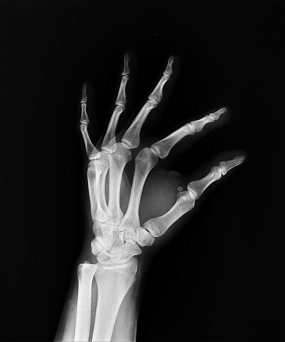 raio x da mão, raio x, saúde, braço, médicos, medicina, osso, hospital, seguro médico, diagnóstico