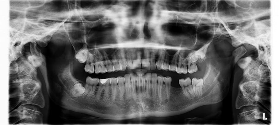 x-ray result, x ray, teeth, tooth missing, human body part, x-ray image, healthcare and medicine, bone, medical x-ray, human teeth