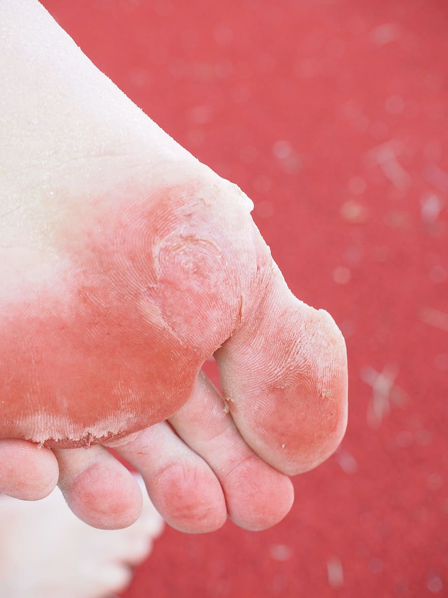 human skin condition, Sole Of The Foot, Cornea, Bubble, foot, expired, skin, abrasion, pain, wound