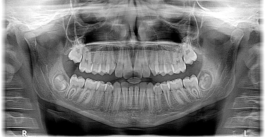 Foto de rayos X, humano, cráneo, rayos X, foto, roentgen, dientes, mandíbula, dentista, ortodoncista