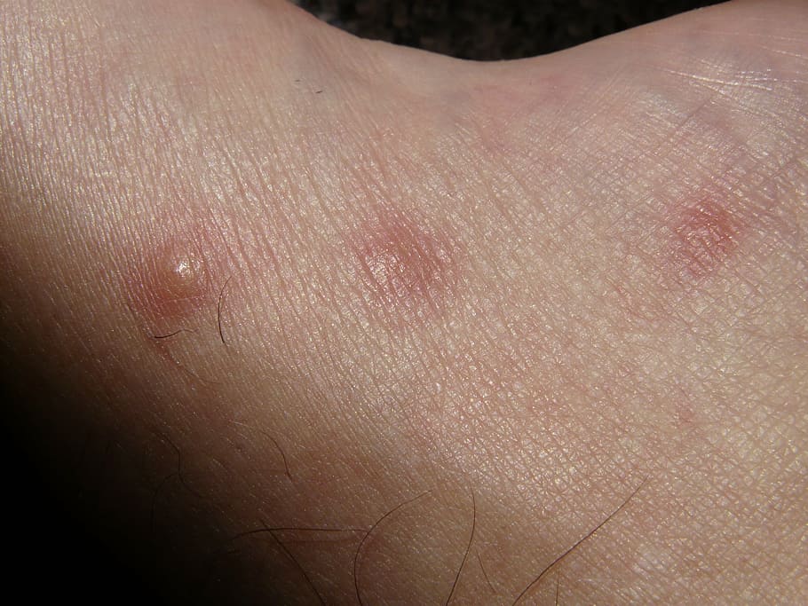 person's skin condition, schnakenstiche, stitches, itching, injection site, allergic reaction, warty, wheal, histamine, redness