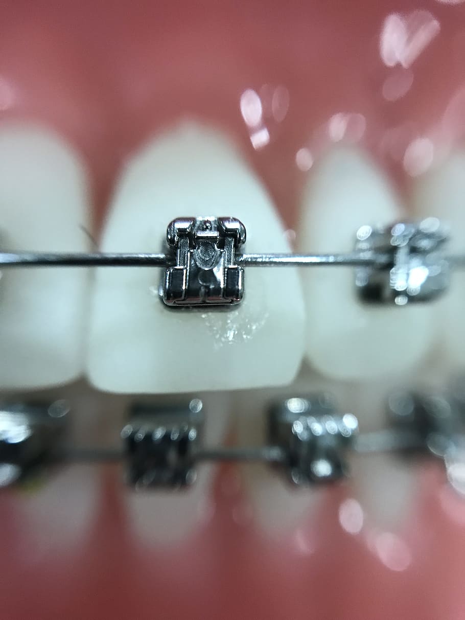 silver teeth braces, Zoom, Orthodontics, Iphone, close-up, macro, selective focus, indoors, day, metal
