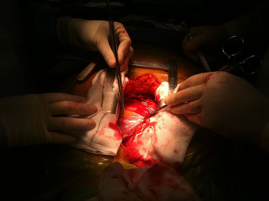 Operation, Open, Heart, Surgery, open, heart, surgery, medicine, human, medical, person, operate