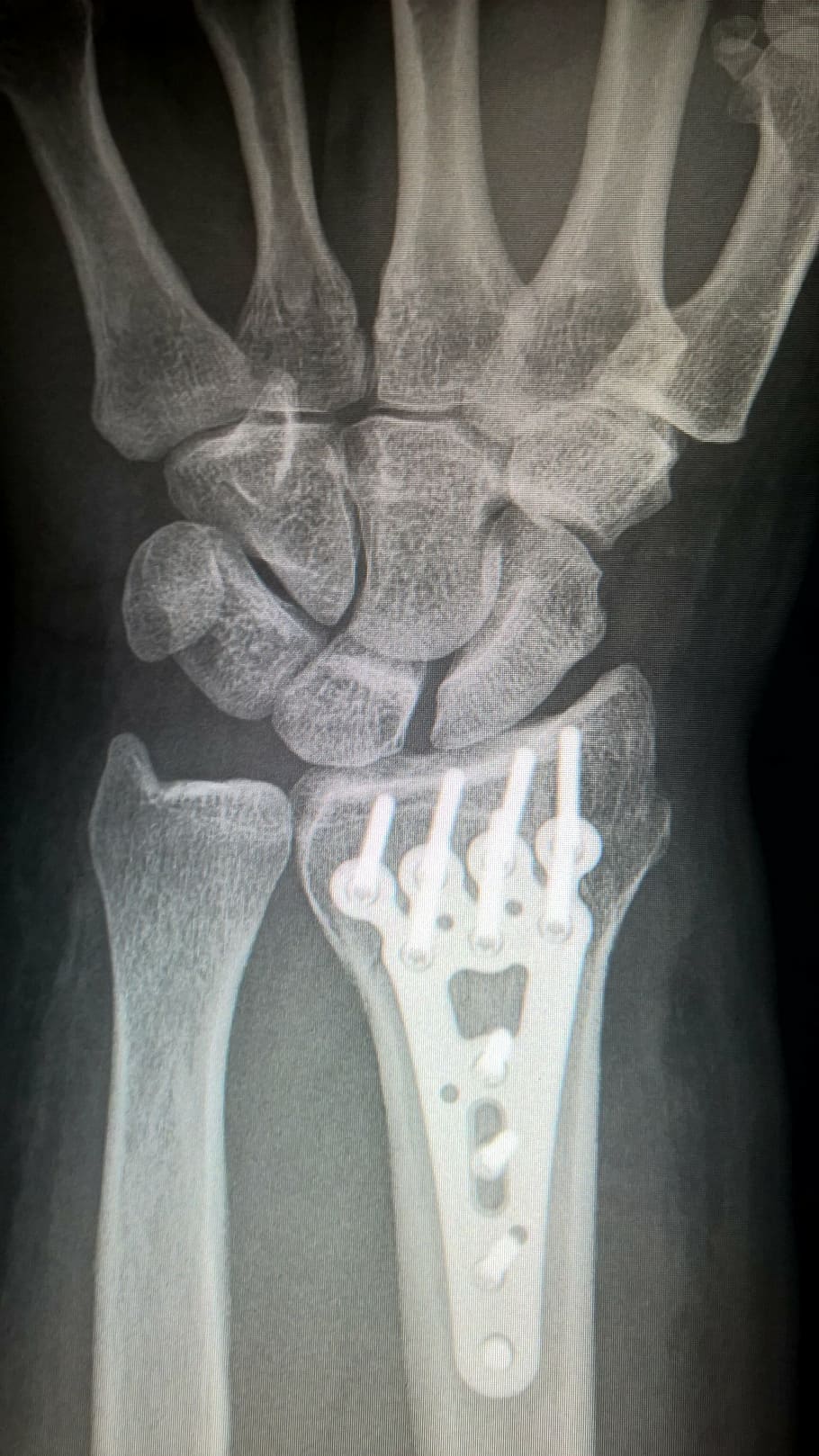 Radiografía de brazo, brazo roto, fijación de placa, placa de titanio, fractura de radio, muñeca, cirugía, cirugía de trauma, imagen de rayos X, hueso