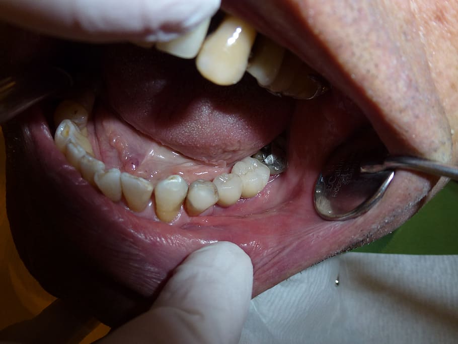 implant, dentistry, dentist, teeth, surgery, human body part, close-up, human teeth, one person, human mouth