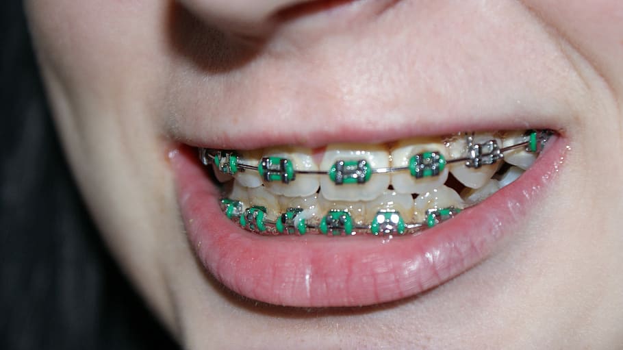 person, green, teeth braces, teeth, braces, tooth, dental braces, bite, mouth, head