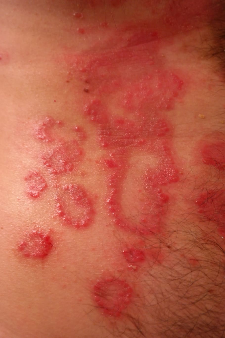 afección de la piel humana, erupción cutánea, inflamado, rojizo, psoriasis, rojo, heutkrankheit, escamoso, piel, enfermedad inflamatoria de la piel