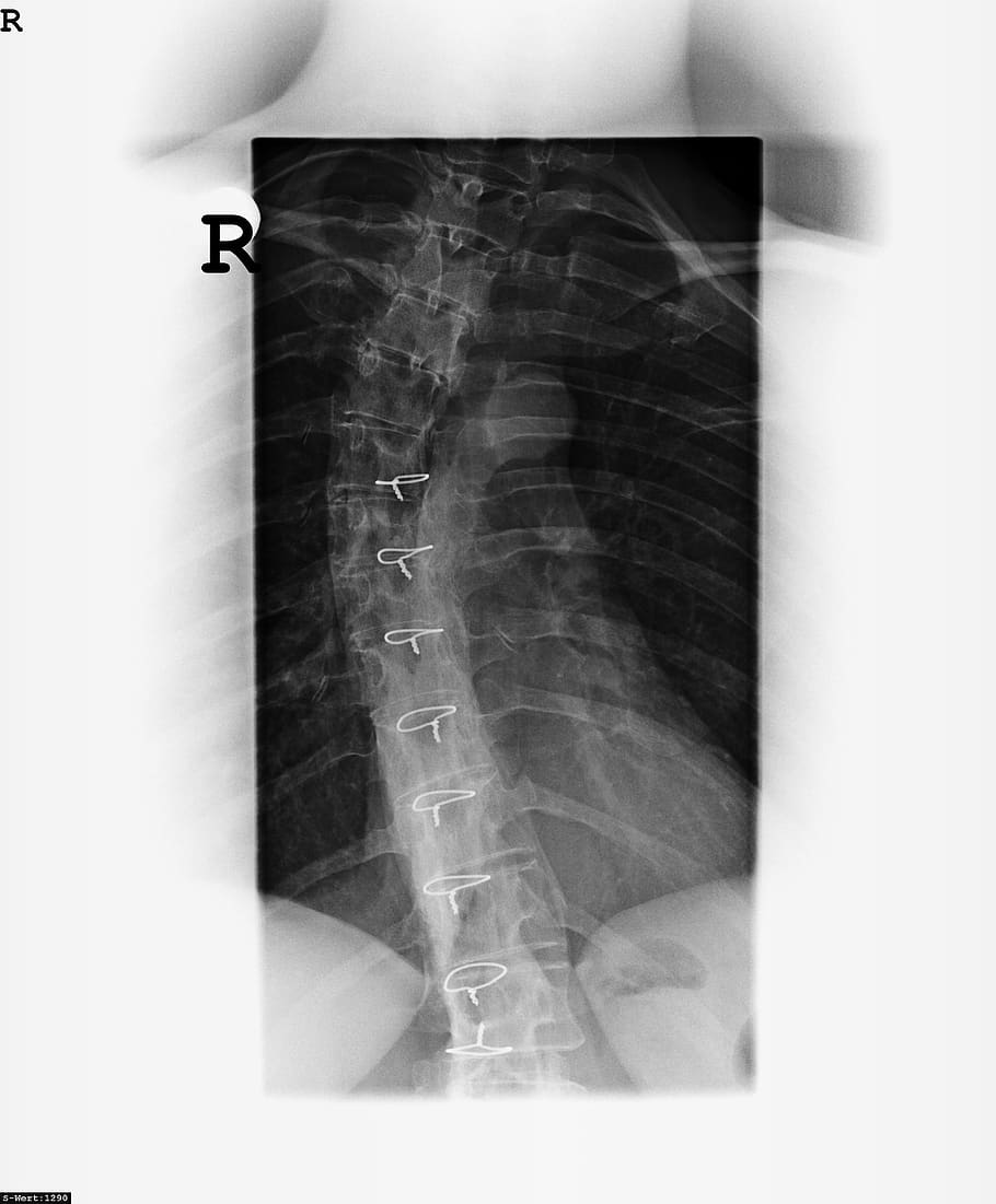 x ray image, bone, spine, move, eddy, intervertebral discs, lumbar disc herniation, clinic, disease, doctor
