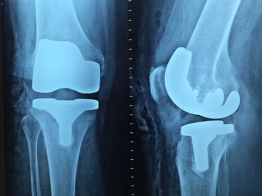 resultado de la radiografía de rodilla, médico, ortopedia, radiografía, rodilla, sin personas, primer plano, azul, interiores, atención médica y medicina